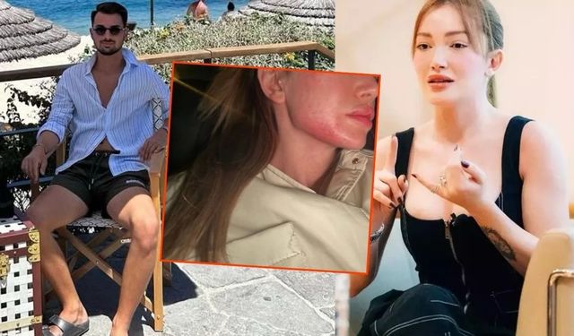 Danla Bilic eski sevgilisi Berk Çetin tarafından darp edildi: Artık dayanamıyorum!